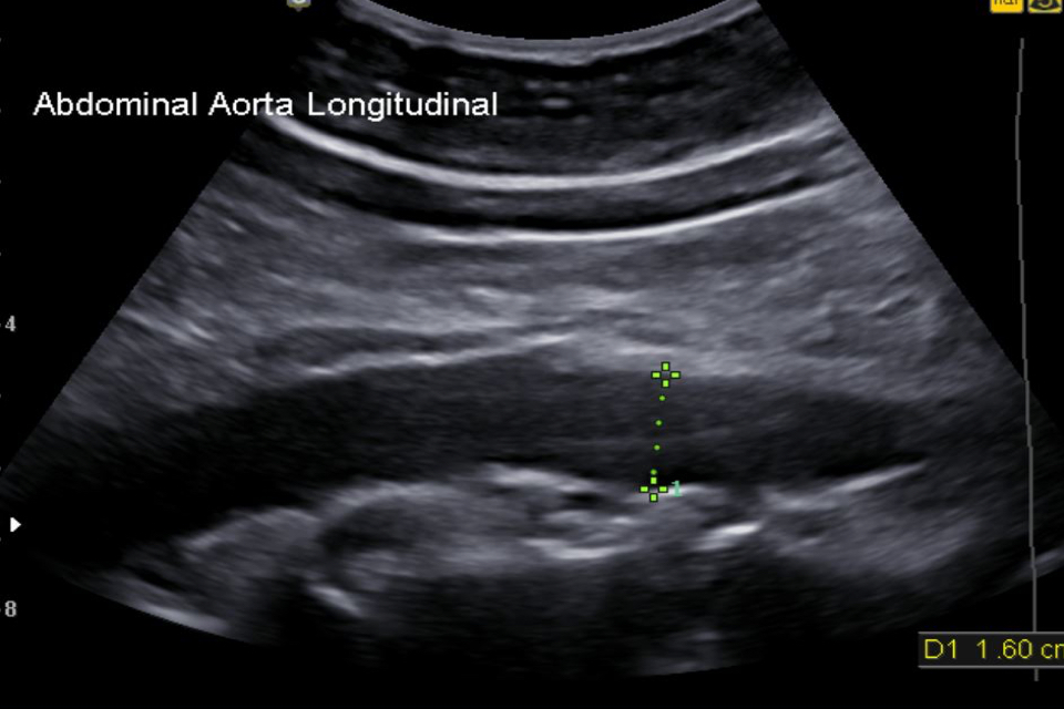 Aortic Screening Ultrasound Durango Colorado