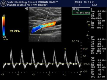 Arterial Ultrasound Durango Colorado