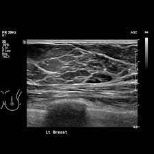 Breast Ultrasound Durango Colorado
