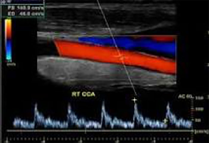 Carotid Ultrasound Durango Colorado