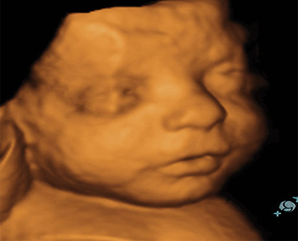Colorado Baby Ultrasound 3d Images