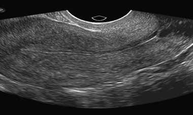 Gynecologic Pelvic Ultrasound Durango Colorado