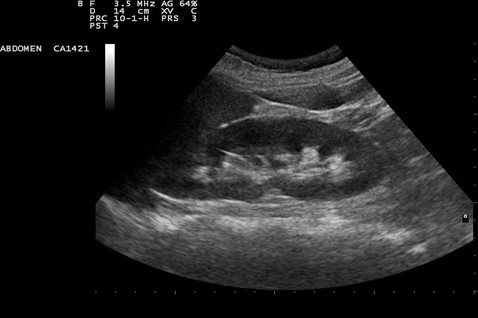 Renal Kidney Ultrasound Durango Colorado
