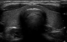 Thyroid Ultrasound Durango Colorado