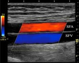 Venous Ultrasound Durango Colorado